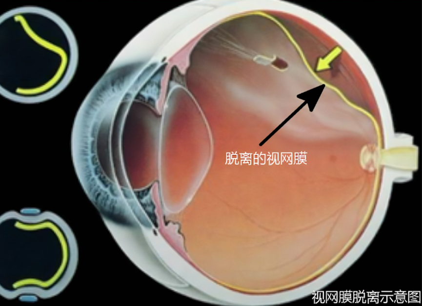 视网膜脱落